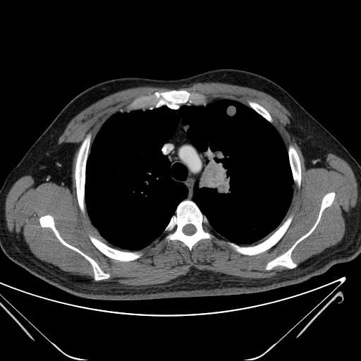 File:Cannonball pulmonary metastases (Radiopaedia 67684-77101 D 80).jpg