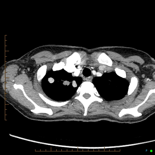 Canonball lung metastasis (Radiopaedia 77634-89837 B 10).jpg