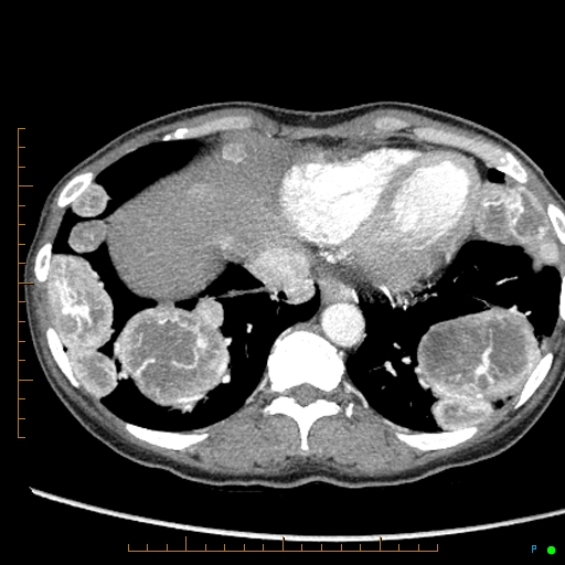 Canonball lung metastasis (Radiopaedia 77634-89837 B 80).jpg