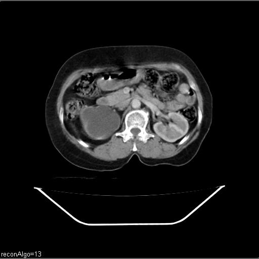 File:Carcinoma cervix- recurrence (Radiopaedia 34702-36137 B 20).jpg