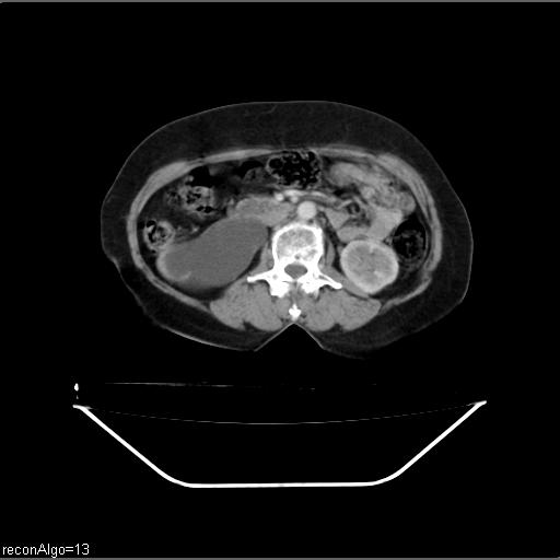 File:Carcinoma cervix- recurrence (Radiopaedia 34702-36137 B 24).jpg