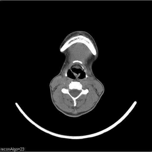 Carcinoma of the maxillary antrum (Radiopaedia 53805-59888 Axial non-contrast 31).jpg