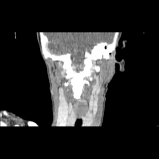 File:Carcinoma of the maxillary antrum (Radiopaedia 53805-59888 Coronal C+ delayed 109).jpg