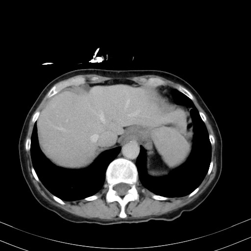 Carcinosarcoma (Radiopaedia 70401-80503 A 10).jpg
