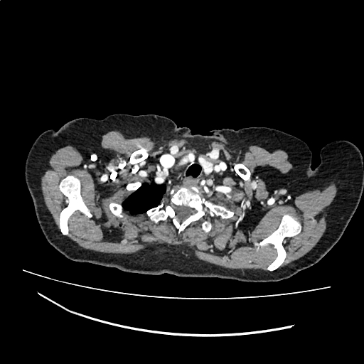 File:Cardiac hydatid disease (Radiopaedia 64684-73611 Axial with contrast 1).jpg
