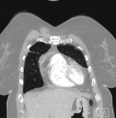 Cardiac sarcoidosis (Radiopaedia 74548-85534 Coronal lung window 9).jpg