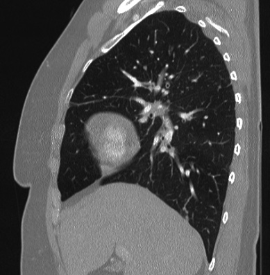 Cardiac sarcoidosis (Radiopaedia 74548-85534 Sagittal lung window 64).jpg