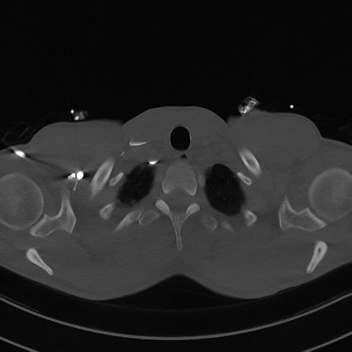 File:Cardiac tumor - undifferentiated pleomorphic sarcoma (Radiopaedia 45844-50134 Axial bone window 5).png