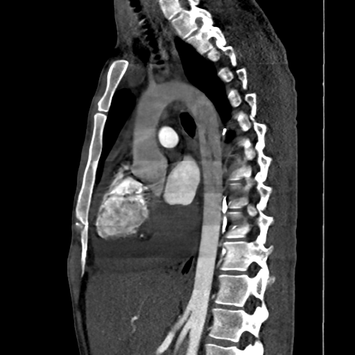 Cardiac tumor - undifferentiated pleomorphic sarcoma (Radiopaedia 45844-50134 B 36).png