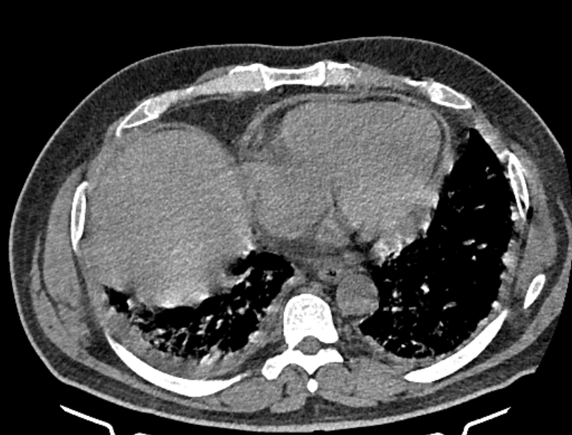 Cardiogenic pulmonary edema (Radiopaedia 68180-77678 Axial non-contrast 37).jpg