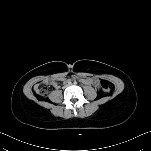 File:Caroli disease with medullary sponge kidney (Radiopaedia 82622-96804 C 45).jpg