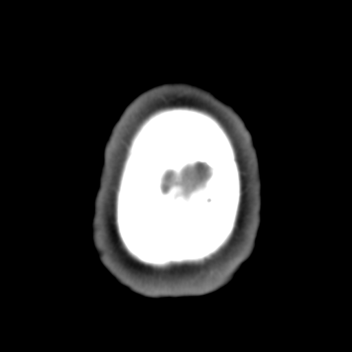 Carotico ophthalmic aneurysm (Radiopaedia 42916-46148 A 5).png