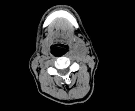 Carotid body tumor (Radiopaedia 61750-69757 Axial non-contrast 46).jpg