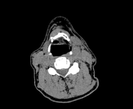 Carotid body tumor (Radiopaedia 61750-69757 Axial non-contrast 58).jpg
