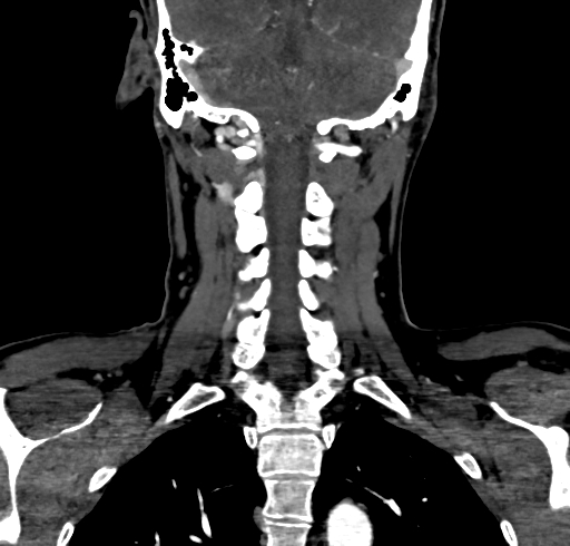 File:Carotid body tumor (Radiopaedia 83615-98727 B 95).jpg