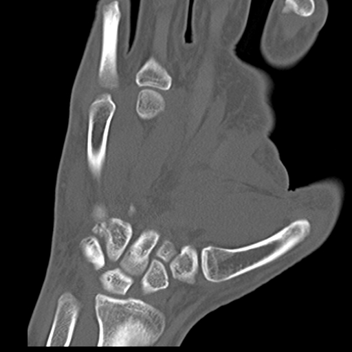 File:Carpo-metacarpal fracture-dislocations with hamatum split fracture (Radiopaedia 18482-18343 Coronal bone window 13).jpg