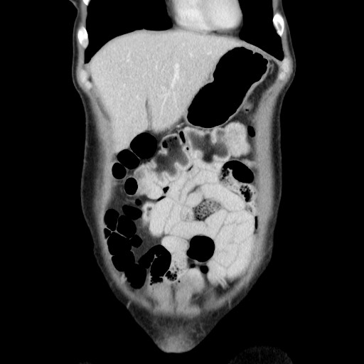 File:Castleman disease with fibrous pseudotumor in the abdomen (Radiopaedia 77296-89373 B 21).jpg