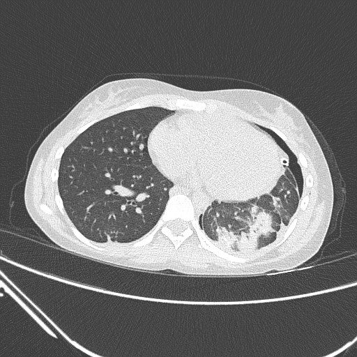 Catamenial pneumothorax (Radiopaedia 27946-28197 lung window 106).jpg