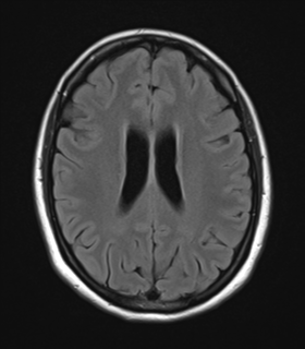 File:Cavernoma with bleed - midbrain (Radiopaedia 54546-60774 Axial FLAIR 20).png