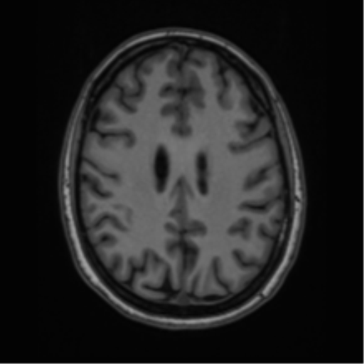 Cavernoma with bleed - midbrain (Radiopaedia 54546-60774 Axial T1 35).png