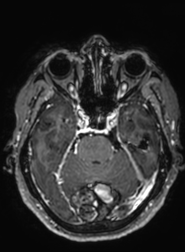 Cavernous hemangioma of the cerebellar falx (Radiopaedia 73025-83724 Axial T1 C+ 232).jpg