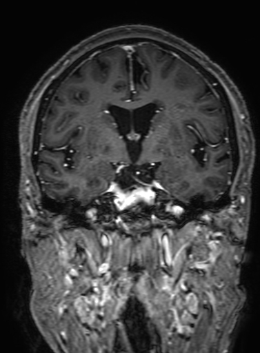 Cavernous hemangioma of the cerebellar falx (Radiopaedia 73025-83724 Coronal T1 C+ 175).jpg