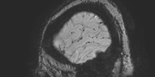 Cavernous hemangioma of the cerebellar falx (Radiopaedia 73025-83724 Sagittal BOLD 16).jpg