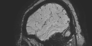 Cavernous hemangioma of the cerebellar falx (Radiopaedia 73025-83724 Sagittal BOLD 25).jpg