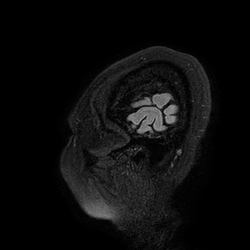 Cavernous hemangioma of the cerebellar falx (Radiopaedia 73025-83724 Sagittal FLAIR 2).jpg