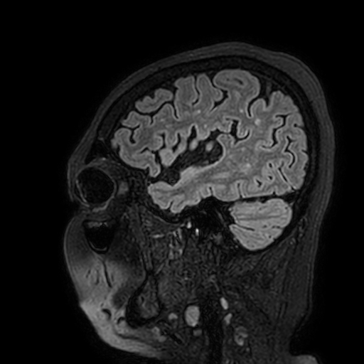 Cavernous hemangioma of the cerebellar falx (Radiopaedia 73025-83724 Sagittal FLAIR 38).jpg