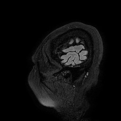 Cavernous hemangioma of the cerebellar falx (Radiopaedia 73025-83724 Sagittal FLAIR 4).jpg
