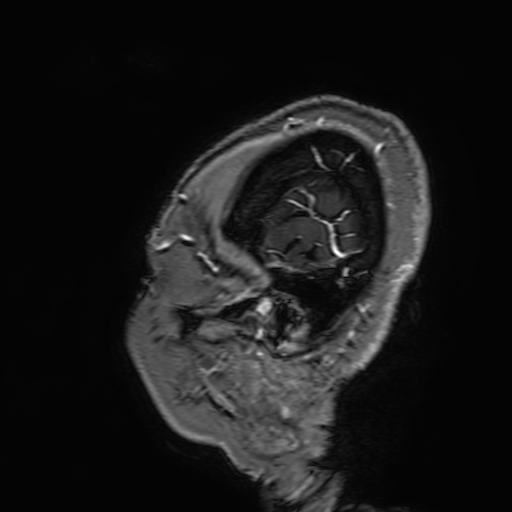 Cavernous hemangioma of the cerebellar falx (Radiopaedia 73025-83724 Sagittal T1 C+ 14).jpg