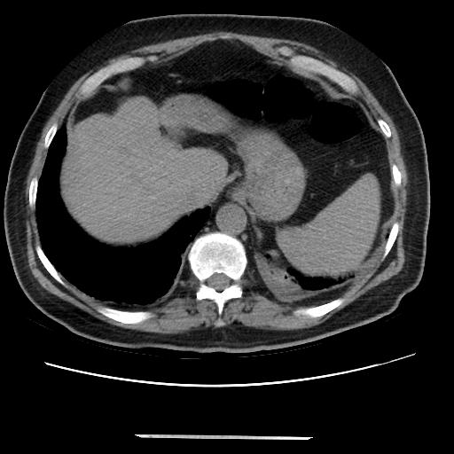 Cavitating pulmonary metastases (Radiopaedia 89545-106544 Axial non-contrast 49).jpg