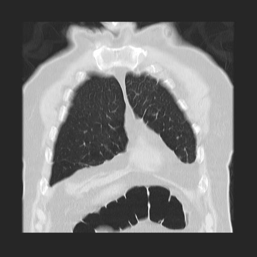 File:Cavitating pulmonary metastases (Radiopaedia 89545-106544 Coronal lung window 8).jpg