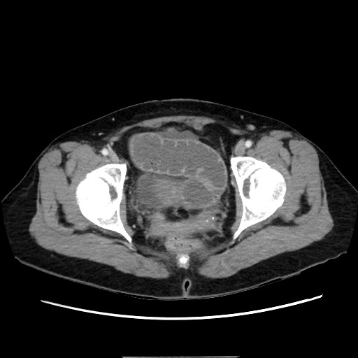 Cecal adenocarcinoma (Radiopaedia 75909-87331 A 81).jpg