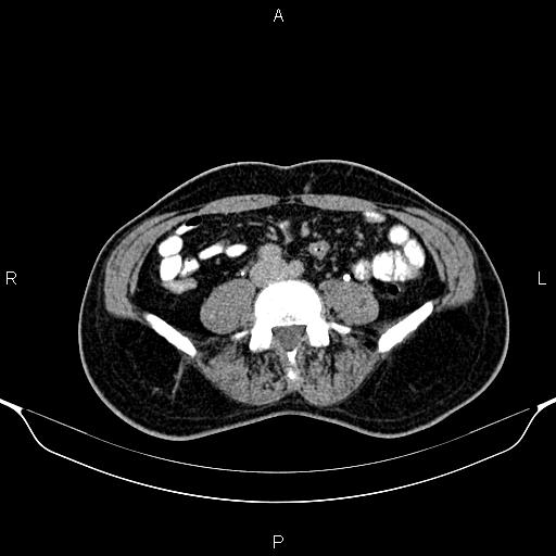Cecal adenocarcinoma (Radiopaedia 85324-100916 Axial C+ delayed 62).jpg