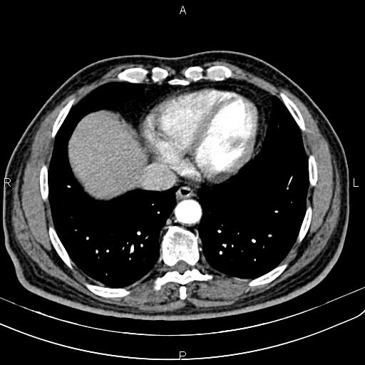 Cecal cancer with appendiceal mucocele (Radiopaedia 91080-108651 A 49).jpg