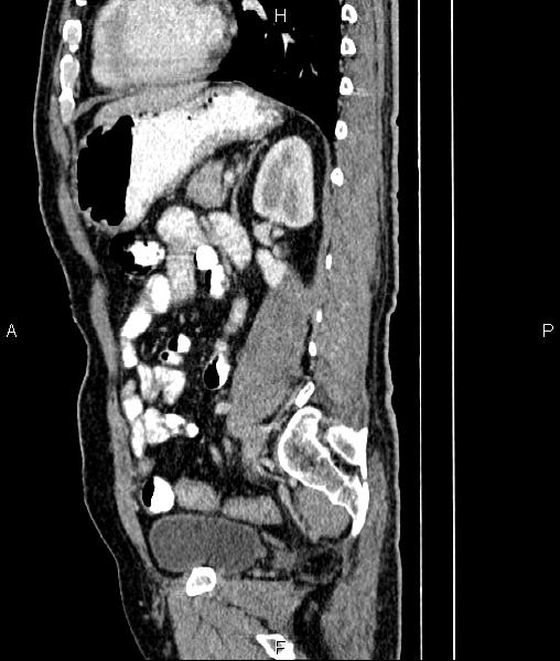 File:Cecal cancer with appendiceal mucocele (Radiopaedia 91080-108651 E 63).jpg