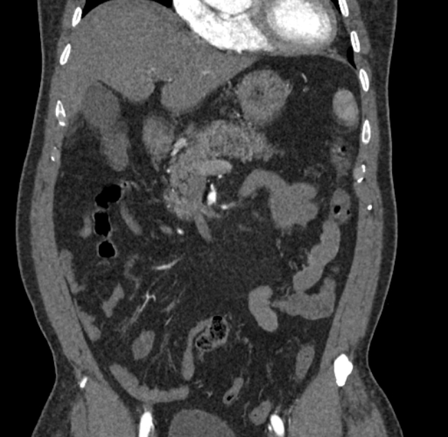 Celiac artery dissection (Radiopaedia 52194-58080 C 19).jpg