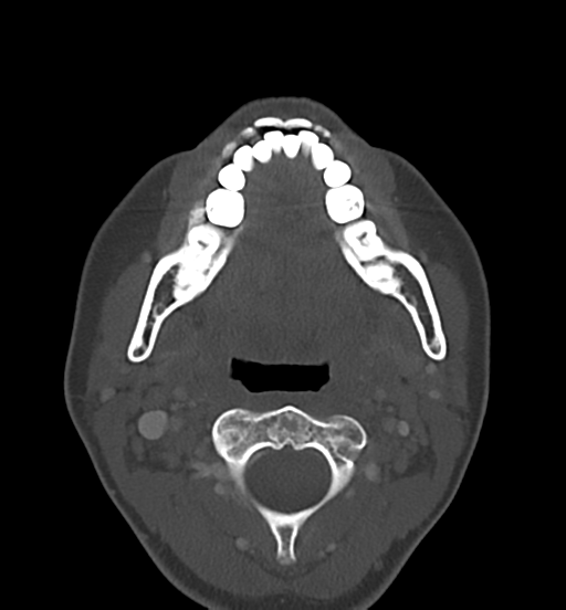 Cemento-ossifying fibroma (Radiopaedia 46243-50643 Axial bone window 40).png