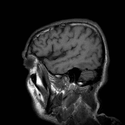 File:Central-variant posterior reversible encephalopathy syndrome (PRES) (Radiopaedia 43880-47359 Sagittal T1 20).jpg
