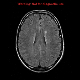 File:Central nervous system vasculitis (Radiopaedia 8410-9235 Axial FLAIR 16).jpg