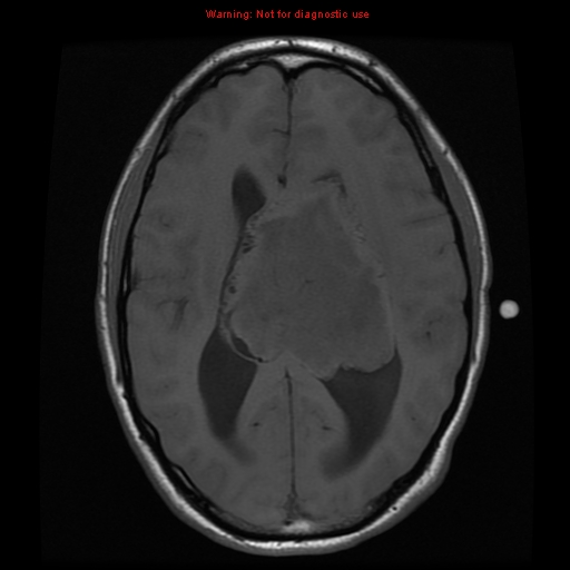 File:Central neurocytoma (Radiopaedia 13188-13206 Axial T1 4).jpg
