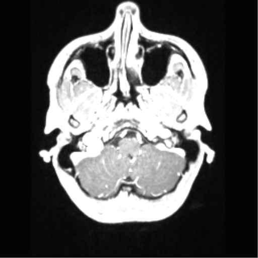 File:Central neurocytoma (Radiopaedia 37664-39557 Axial T1 C+ 14).png