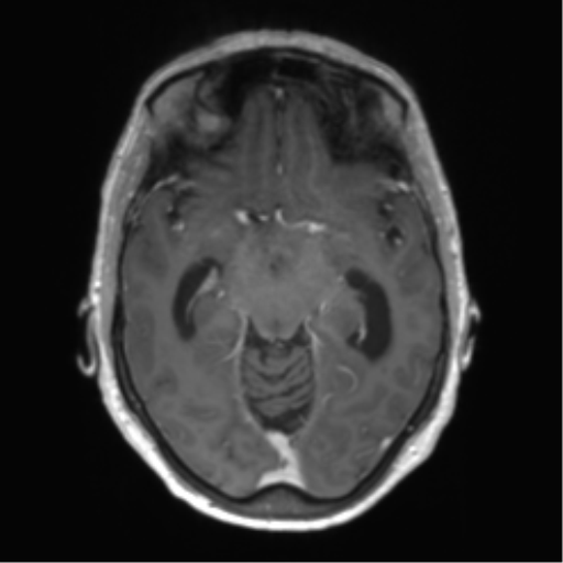 Central neurocytoma (Radiopaedia 65317-74345 Axial T1 C+ 20).png