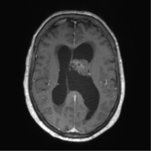 Central neurocytoma (Radiopaedia 65317-74345 Axial T1 C+ 33).png