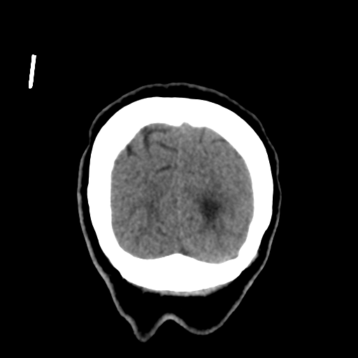 File:Central neurocytoma (Radiopaedia 65317-74346 Coronal non-contrast 55).png