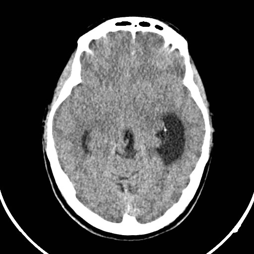 Central neurocytoma (Radiopaedia 84497-99871 Axial non-contrast 19).jpg