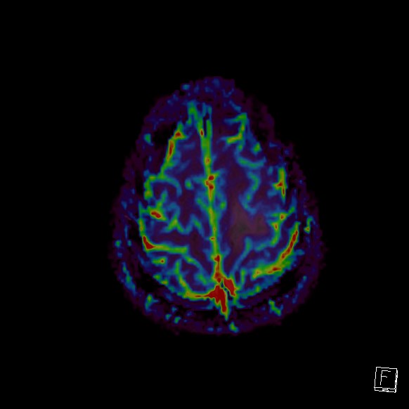 Central neurocytoma (Radiopaedia 84497-99872 Axial Perfusion 41).jpg