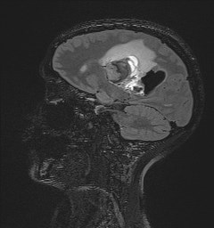 File:Central neurocytoma (Radiopaedia 84497-99872 Sagittal Flair + Gd 94).jpg